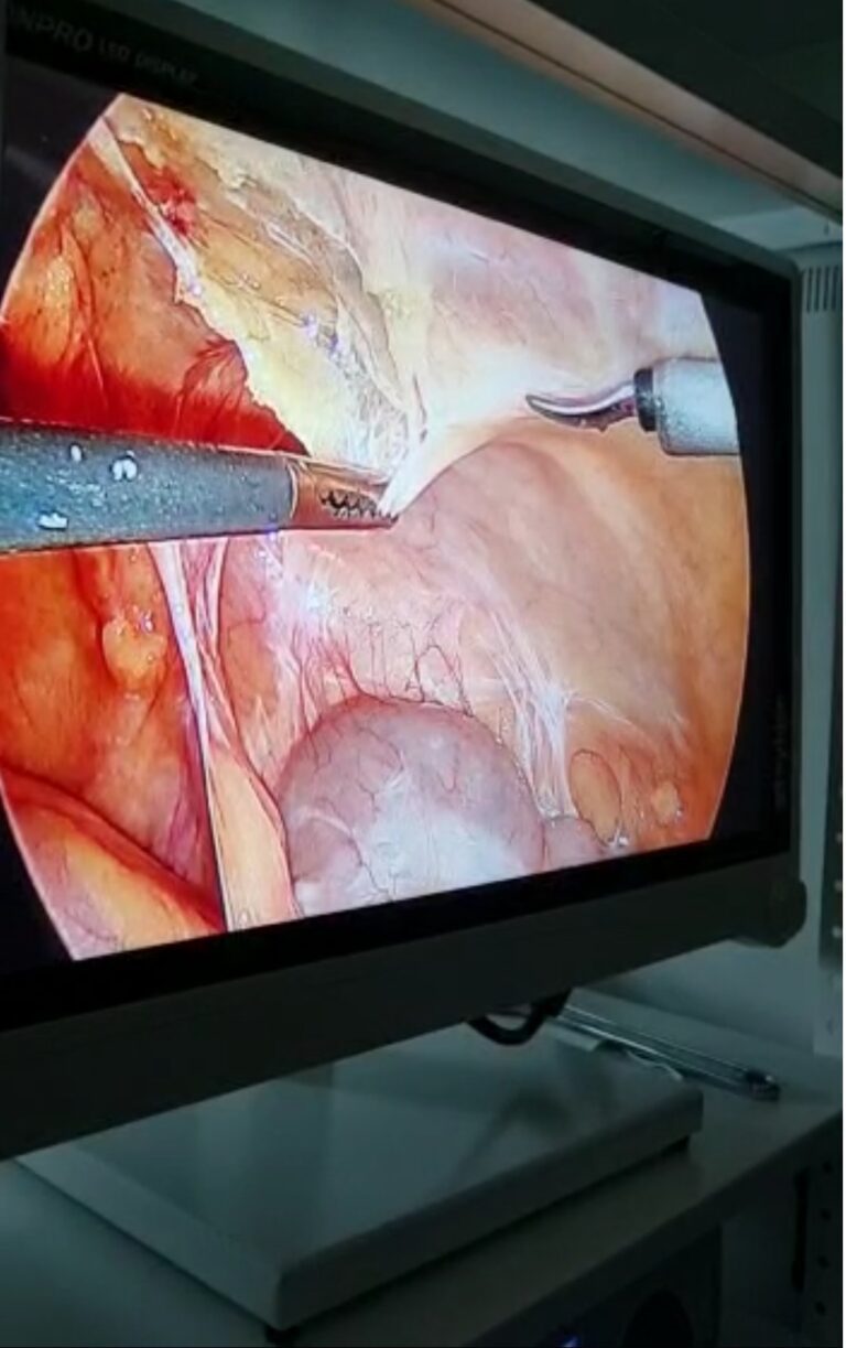 quanto custa videolaparoscopia